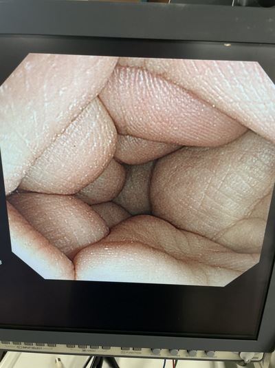 Video Colonoscope&nbsp;|&nbsp;OLYMPUS&nbsp;|&nbsp;CF-Q260AI