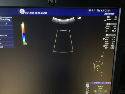 Color Doppler&nbsp;|&nbsp;GE&nbsp;|&nbsp;Logiq S7 Expert