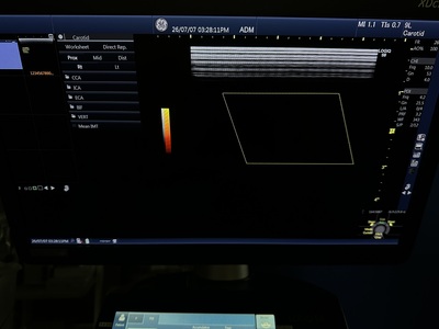 Color Doppler&nbsp;|&nbsp;GE&nbsp;|&nbsp;Logiq S8 XDclear