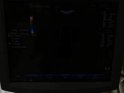 Color Doppler&nbsp;|&nbsp;GE&nbsp;|&nbsp;LOGIQ P5