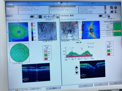 OCT&nbsp;|&nbsp;Carl Zeiss&nbsp;|&nbsp;Cirrus 4000 HD OCT