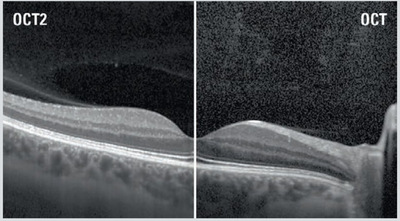 OCT&nbsp;|&nbsp;Heidelberg Engineering GmbH&nbsp;|&nbsp;SPECTRALIS OCT2