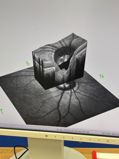 HRA2+ OCT+ WWE(55°), Retina and Glaucoma Module&nbsp;|&nbsp;Heidelberg Engineering GmbH&nbsp;|&nbsp;SPECTRALIS OCT2