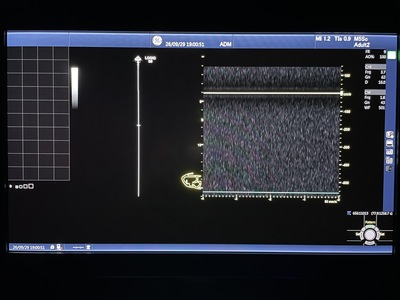 Color Doppler&nbsp;|&nbsp;GE&nbsp;|&nbsp;Logiq S8 XDclear