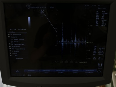 Color Doppler&nbsp;|&nbsp;GE&nbsp;|&nbsp;LOGIQ P5