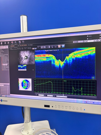ANGIOGRAPHY Installed. No injections required. An unprecedented, high-definition 3D map of retinal blood flow drawn with light.&nbsp;|&nbsp;NIDEK&nbsp;|&nbsp;RS-3000 Advance