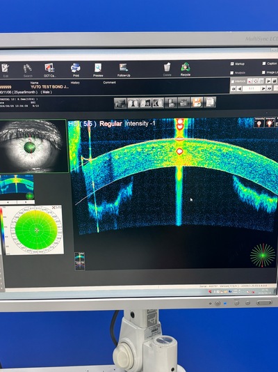 Fully Refurbished OCT with Angiography + Anterior Lens kit&nbsp;|&nbsp;NIDEK&nbsp;|&nbsp;RS-3000 Advance