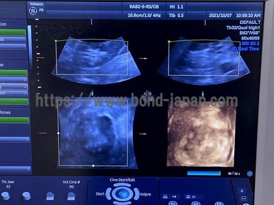 4D Ultrasound | GE | Voluson P8