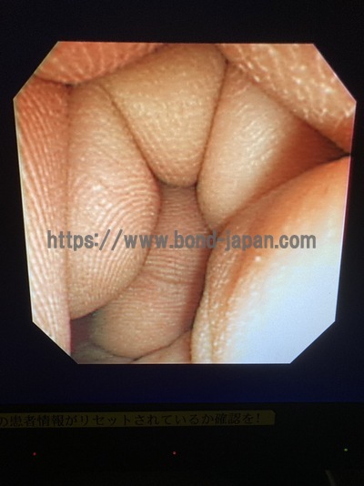 Video Gastroscope | OLYMPUS | GIF-XP260N