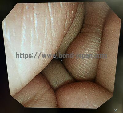 Video Duodenoscope | OLYMPUS | TJF-260V