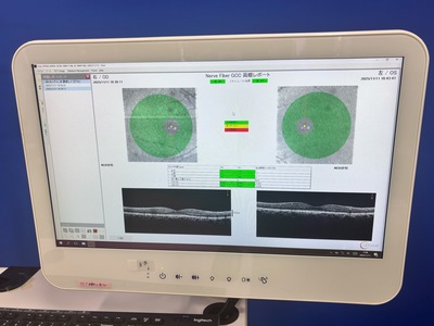 Optovue iVue 100 2019 with Gen 2 Monitor | OptoView | iVue 100