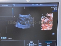 4D Ultrasound | GE | Voluson E8 Expert