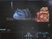 4D Ultrasound | GE | Voluson E6