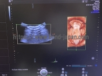 4D Ultrasound | GE | Voluson E10