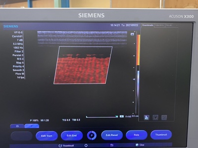 Color Doppler | SIEMENS | X300 PE