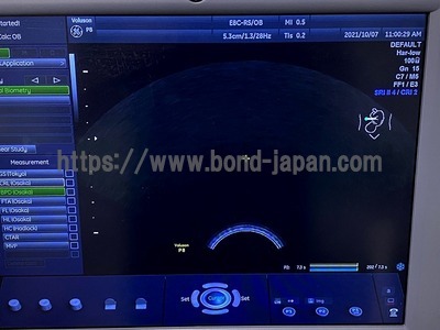4D Ultrasound | GE | Voluson P8