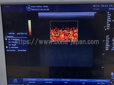 Color Doppler&nbsp;|&nbsp;GE&nbsp;|&nbsp;LOGIQ P5