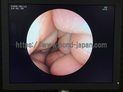 Video Gastroscope | FUJIFILM | EG-3000N