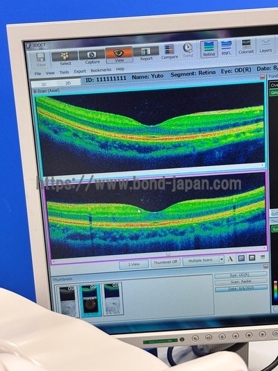 OCT with Non-mydriatic retinal camera | TOPCON | 3D OCT 1 / Maestro 1