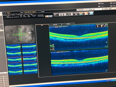 Optical Coherence Tomography・OCT&nbsp;|&nbsp;NIDEK&nbsp;|&nbsp;RS-3000 Advance