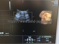 4D Ultrasound | GE | Voluson E8 Expert