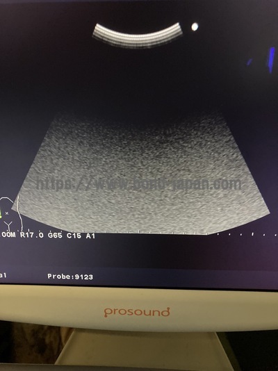 Color Doppler | HITACHI | Prosound α6