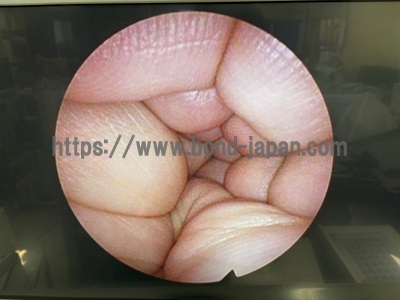 Arthroscope | OLYMPUS | A70940A