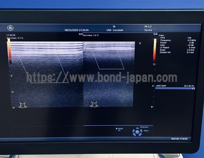 Color Doppler | GE | Vivid E95 Urtla Edition
