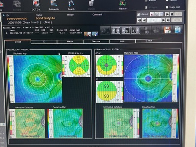 Optical Coherence Tomography ・OCT&nbsp;|&nbsp;NIDEK&nbsp;|&nbsp;RS-3000 Lite
