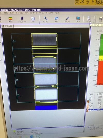 X-ray Bone Densitometer | GE | Prodigy