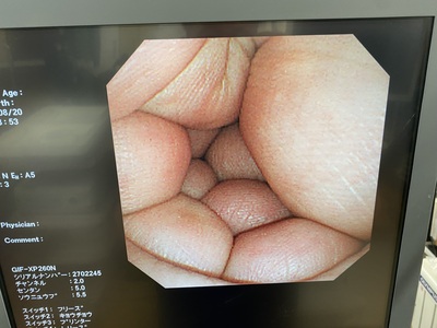 Video Gastroscope&nbsp;|&nbsp;OLYMPUS&nbsp;|&nbsp;GIF-XP260N