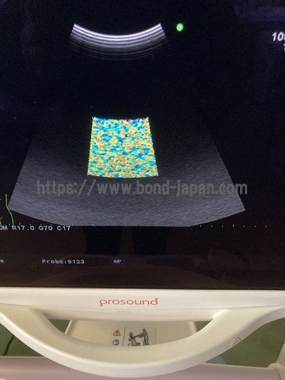 Color Doppler | HITACHI | Prosound α6