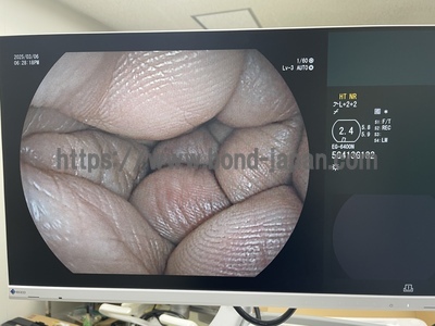 Video Gastroscope | FUJIFILM | EG-6400N