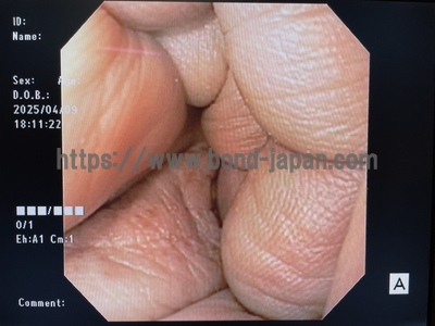 Video Gastroscope | OLYMPUS | GIF-140