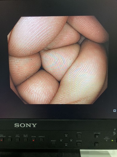 Video Colonoscope&nbsp;|&nbsp;OLYMPUS&nbsp;|&nbsp;PCF-H290I