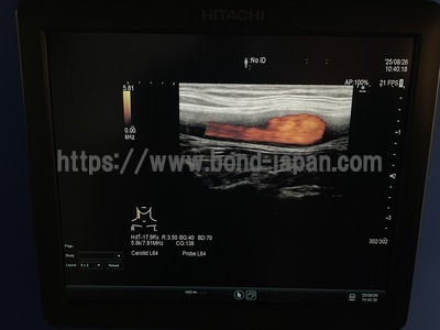Ultrasound System | HITACHI | ARIETTA 60