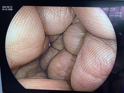 Colonoscope&nbsp;|&nbsp;FUJIFILM&nbsp;|&nbsp;EC-L600ZP7