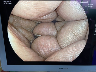 Colonoscope&nbsp;|&nbsp;FUJIFILM&nbsp;|&nbsp;EC-L600ZP7