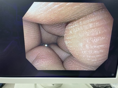 Video Gastroscope&nbsp;|&nbsp;OLYMPUS&nbsp;|&nbsp;GIF-H170