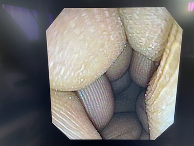 Video Gastroscope | OLYMPUS | GIF-XP150N