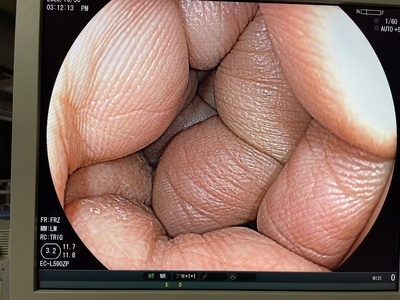 大腸スコープ | 富士フイルムメディカル株式会社 | EC-L590ZPの写真