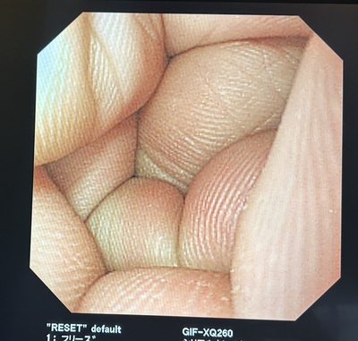 Video Gastroscope&nbsp;|&nbsp;OLYMPUS&nbsp;|&nbsp;GIF-XQ260