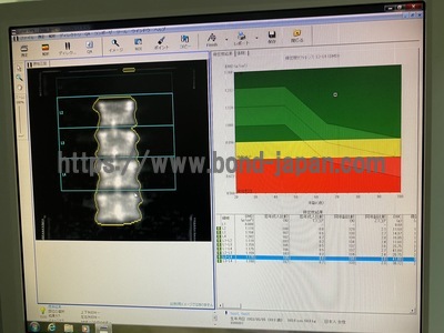 X-ray Bone Densitometer | GE | DPX BRAVO