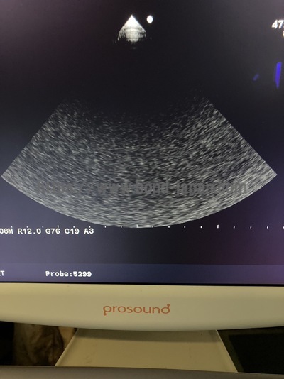 Color Doppler | HITACHI | Prosound α6