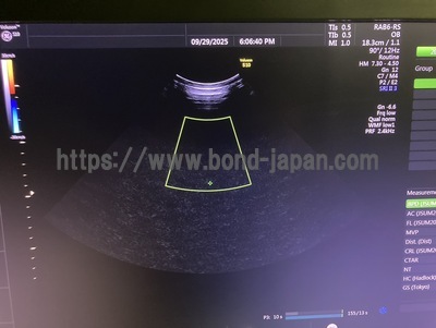 4D Ultrasound | GE | Voluson S10 BT16
