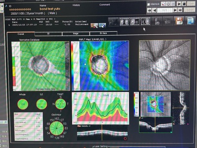 Optical Coherence Tomography ・OCT&nbsp;|&nbsp;NIDEK&nbsp;|&nbsp;RS-3000 Lite