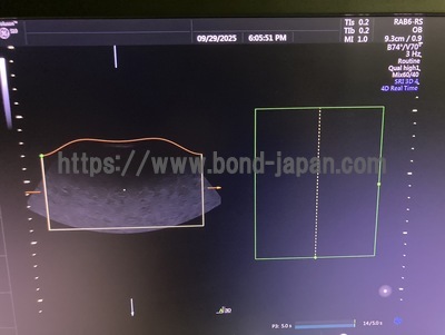 4D Ultrasound | GE | Voluson S10 BT16