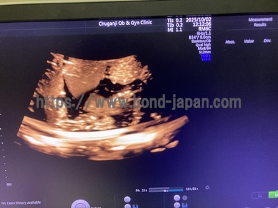 4D Ultrasound | GE | Voluson E10 BT17